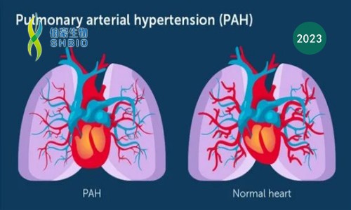 心跳的感觉 |Olink 助力肺动脉高压患者右心室衰竭标志物 LTBP- 2 筛选
