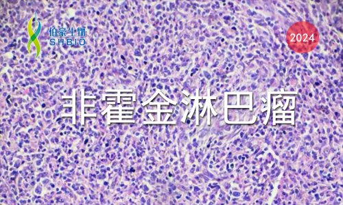 文献解读 | PD- 1 在 T 细胞淋巴瘤中相关抑制代谢程序，限制糖酵解和抑制 AP- 1 活性