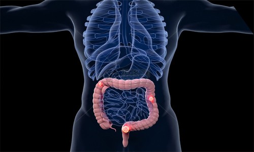 文献解读 | 单细胞转录组分析揭示了蛋白酪氨酸激酶在结直肠肿瘤发生过程中的作用