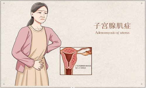 文献解读 | 单细胞 RNA 测序与空间转录组学相结合破译的子宫腺肌病综合转录图谱